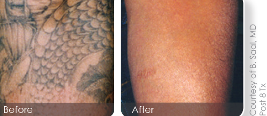 Tattoo-Removal.png