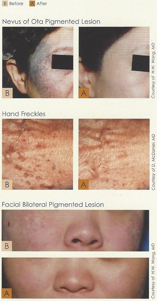 Pigment_before_after