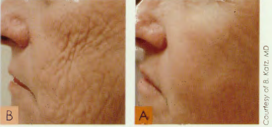 Wrinkle_before_after